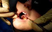 Lười đánh răng, coi chừng nguy cơ ung thư miệng và dạ dày