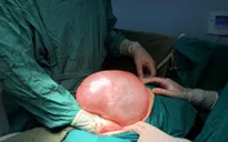 Khối u nang buồng trứng nặng gần 9kg lấp đầy ổ bụng người phụ nữ