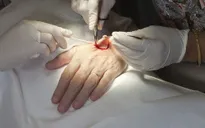 Đã có miếng dán truyền thuốc điều trị ung thư da không gây đau đớn?