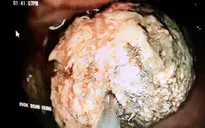 Loét dạ dày, xuất huyết tiêu hóa sau khi ăn quả bứa, uống trà sữa trân châu