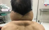 "Biến" thành... người khổng lồ sau nhiều năm nghiện rượu