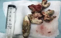 Lấy sỏi san hô gần 12cm lấp đầy các đài thận