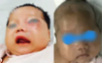 Cứu bé sơ sinh nhiễm trùng hiếm gặp, gây áp xe hốc mắt