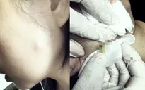 Một phụ nữ bị áp xe trên má sau tiêm botox thu gọn hàm