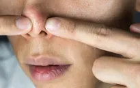 Nhiễm trùng nghiêm trọng từ thói quen nặn mụn trên mũi