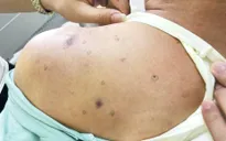 Bị ong vò vẽ đốt hơn 40 nốt, người đàn ông nguy kịch