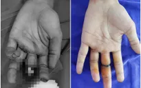 Làm chủ kỹ thuật vi phẫu nối chi thể đứt rời phức tạp