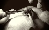 Một phụ nữ đứt lìa trụ mũi sau khi tin "bác sĩ" thẩm mỹ dạo