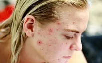 7 mẹo nhỏ giải cứu làn da “vỡ trận” vì mụn
