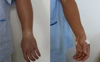 Đi phát rẫy, bị ong vò vẽ đốt 40 vết phải nhập viện