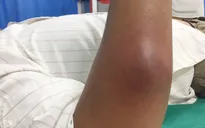 Mụn viêm gây áp xe - Tình trạng da nguy hiểm chớ coi thường