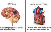 Sự khác biệt giữa đột quỵ và nhồi máu cơ tim