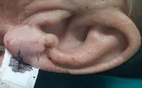 Nguy hiểm: Bố đột quỵ não, con trai lấy dao cứa tai chích máu theo chỉ dẫn trên mạng