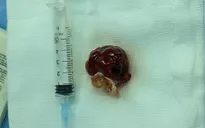 Cứu sống bệnh nhân vừa bị u nhầy nhĩ trái kèm hở nặng van động mạch chủ
