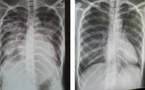 Cứu sống sản phụ bị phù phổi cấp do tiền sản giật nặng