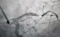 Thường xuyên hút thuốc lá, người đàn ông bị nhồi máu cơ tim cấp, biến chứng ngừng tuần hoàn