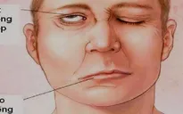Nhiệt độ giảm sâu, số người bị méo miệng, liệt mặt tăng cao