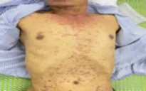 Nổi mụn nước toàn thân sau khi dùng thuốc điều trị đái tháo đường mua trên mạng