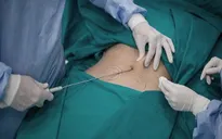 Một phụ nữ 50 tuổi tử vong sau 3 ngày hút mỡ bụng