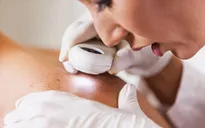 Những triệu chứng ung thư da không thể bỏ qua