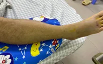Bị rắn cắn khi đi lấy củi, người đàn ông bị rối loạn đông máu