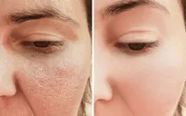 7 mẹo thu nhỏ lỗ chân lông tự nhiên được chuyên gia khuyên dùng