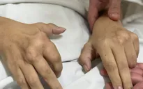 Biến dạng khớp do bệnh gout, bệnh nhân phải phẫu thuật thay khớp gối 2 bên