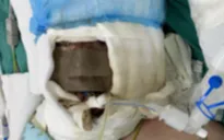 Xông thuốc lá phòng COVID-19, bé gái bị bỏng nước sôi nguy kịch