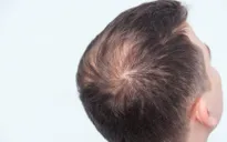Các nhà khoa học Nhật Bản tìm ra tế bào gốc giúp tái tạo tóc