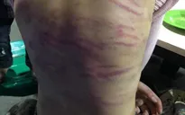 Bé gái 12 tuổi ở Hà Nội bị mẹ đẻ và người tình đánh đập dã man