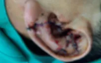 Va vào tường, người đàn ông bị đứt lìa tai