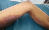 Đi cắt cỏ bị rắn cắn, cụ ông 92 tuổi nguy kịch