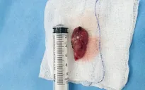 Suýt liệt do u tủy ngực