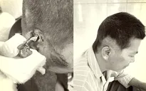 Tổn thương tai gần đứt lìa do tai nạn giao thông