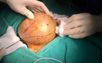 Bướu giáp khổng lồ - Chớ nên xem thường