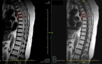 Bơm xi măng điều trị cho bệnh nhân xẹp đốt sống do ngã đập lưng trên sàn cứng