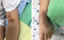 Phát hiện trẻ 3 tuổi mắc ban xuất huyết hiếm gặp