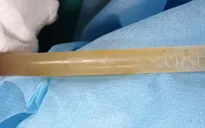 Cứu bệnh nhân chảy dịch bạch huyết sau chấn thương ngực gãy 8 xương sườn