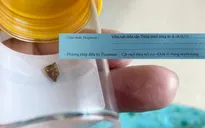 Tình cờ phát hiện dị vật trong ruột, viêm ruột thừa khi đi tầm soát sức khỏe