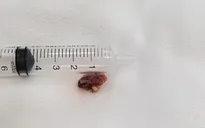 Đau đầu lâu ngày, đi khám phát hiện có khối u trong não