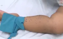Trẻ mắc tay chân miệng kín các phòng bệnh