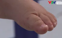 Nhiều trẻ mắc tay chân miệng nhập viện muộn