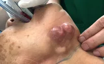 Phát hiện ung thư tuyến nước bọt giai đoạn muộn vì chần chừ điều trị