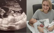 Hiếm gặp: Có bầu khi đang mang thai 3 tháng