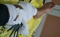 Va chạm với xe ba gác chở sắt, nam thanh niên bị 11 thanh sắt đâm xuyên chân