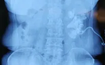 Người phụ nữ có sỏi san hô rải rác khắp thận, nhiều bệnh viện "từ chối" phẫu thuật
