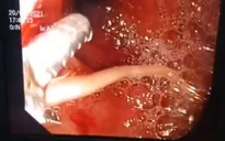 Bé 5 tuổi viêm tụy cấp do giun dài 15cm chui vào ống tụy