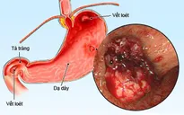 Phụ thuộc corticoid - bài học đắt giá