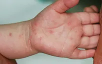 Nhiều bệnh nhi mắc tay chân miệng