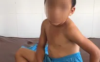 Bé trai 6 tuổi bị cha dượng bạo hành, châm thuốc lá đang cháy vào người